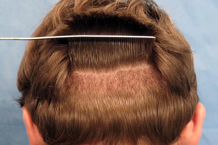 Hair Transplant Method