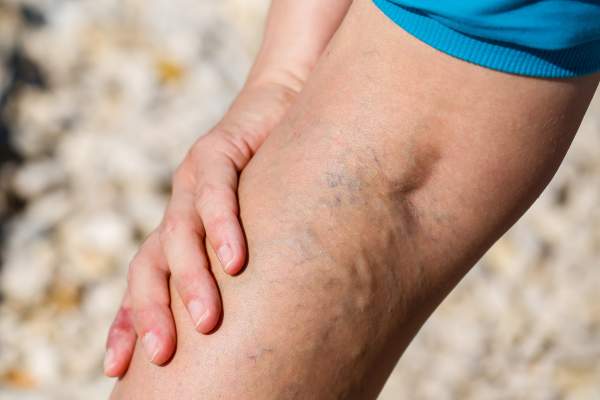 Varicose Veins Treatment